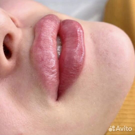 Инъекции ботокса в губы