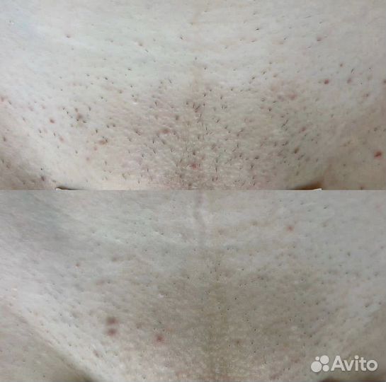 Лазерная эпиляция