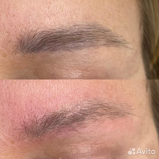 Обучение удаление татуажа лазером