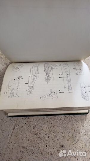 Иглоукалывание