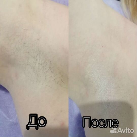Шугаринг