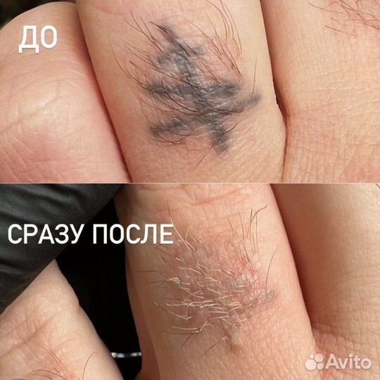 Удаление татуажа