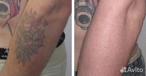 Лазерное удаление тату