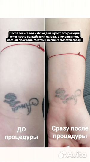 Удаление татуировоки и перманентного макияжа