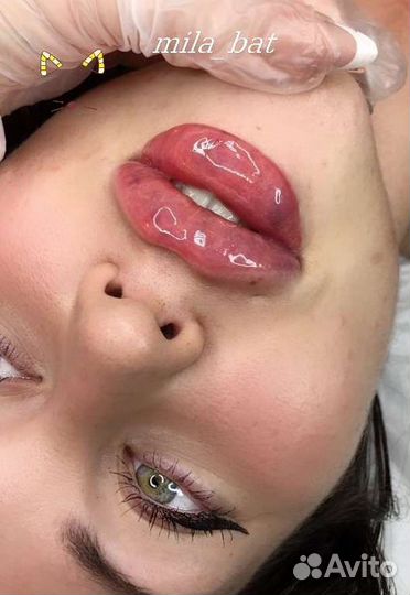 Косметолог Увеличение губ Контурная Fullface
