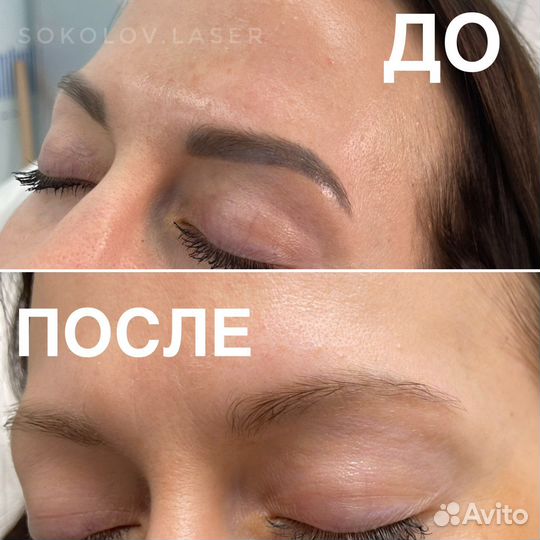 Удаление тату и татуажа в клинике Sokolov Laser