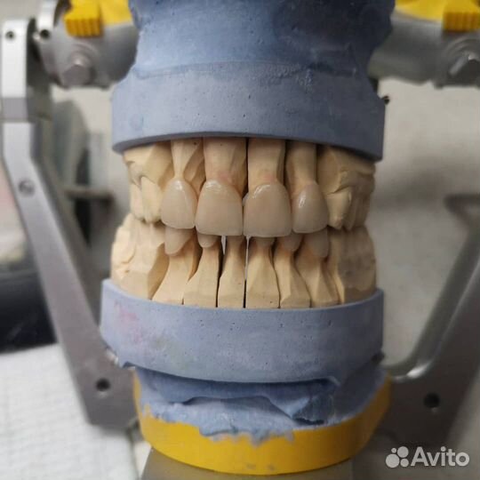 Изготовление безметалловых коронок, виниров е-max