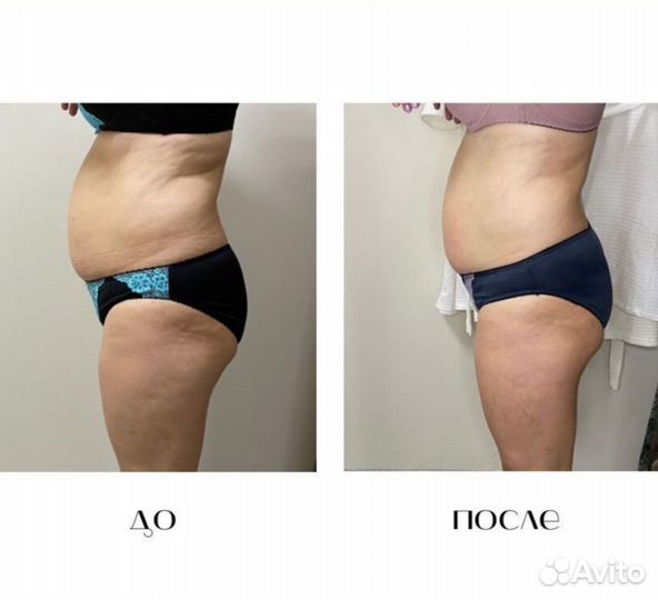 Аппаратный антицеллюлитный массаж