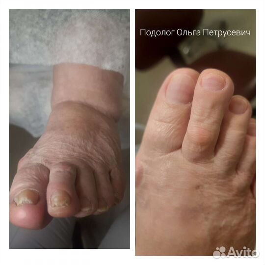 Подолог-вросший ноготь,стержневая мозоль