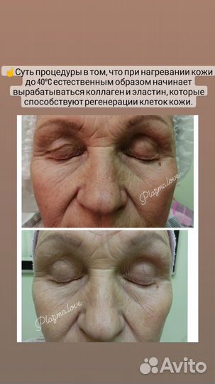 Удаление папиллом