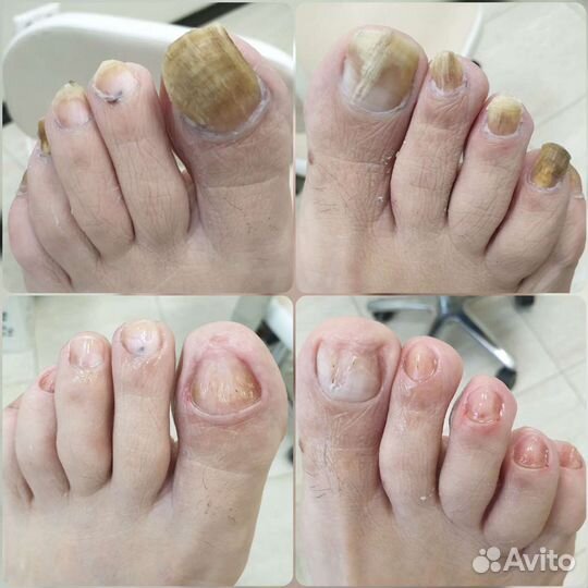 Педикюр медицинский, эстетический