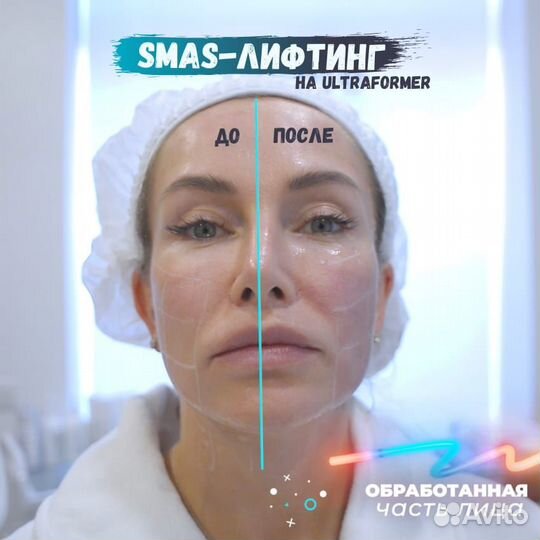 Требуются модели на Smas лифтинг