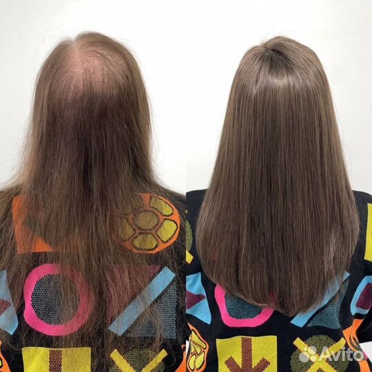 Система замещения волос при алопеции модель