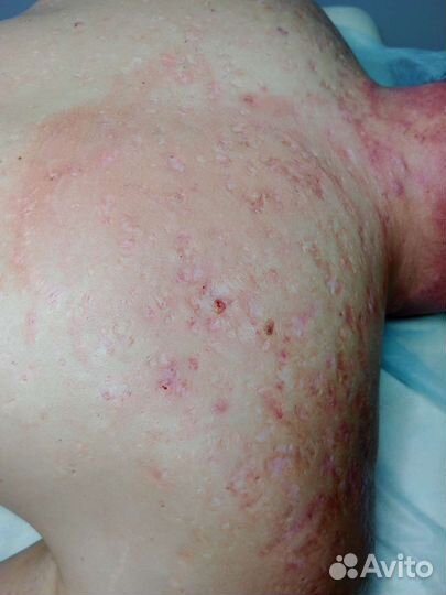 Чистка лица,пилинг,борьба с акне,постакне и др