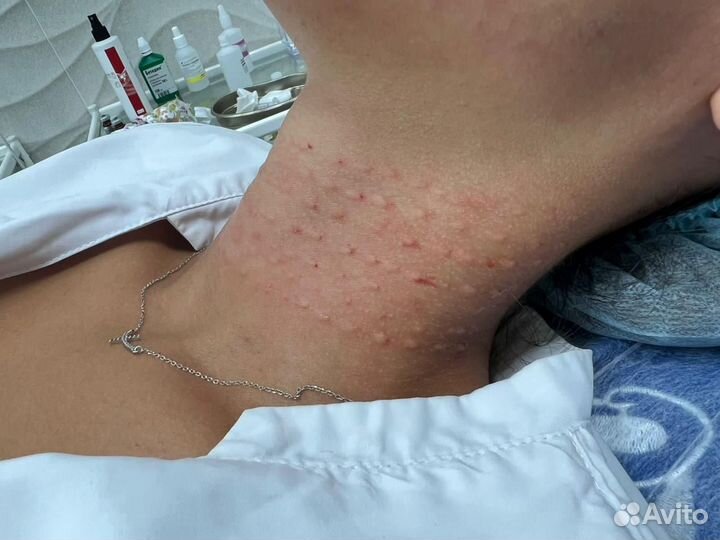 Биоревитализация лица и мезотерапия