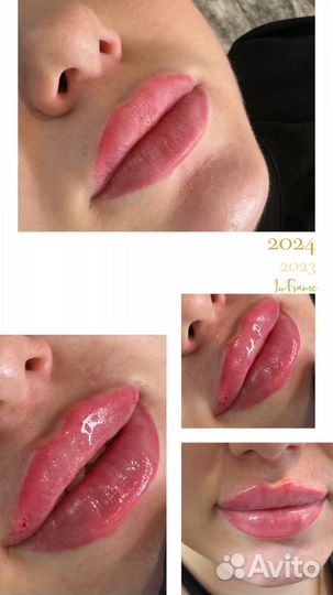 Увеличение губ филлером