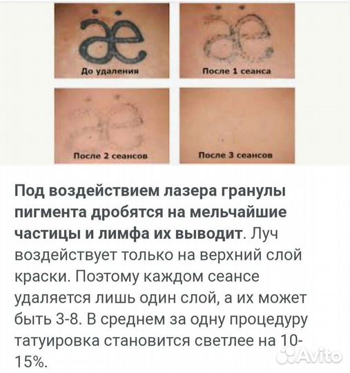 Удаление тату