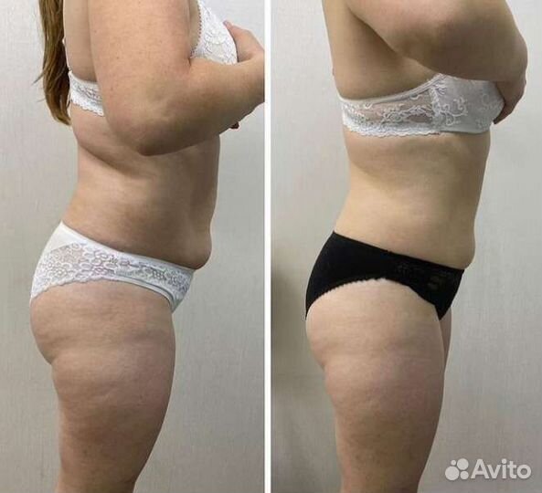 LPG массаж, Классический, Кавитация,smas-лифтинг