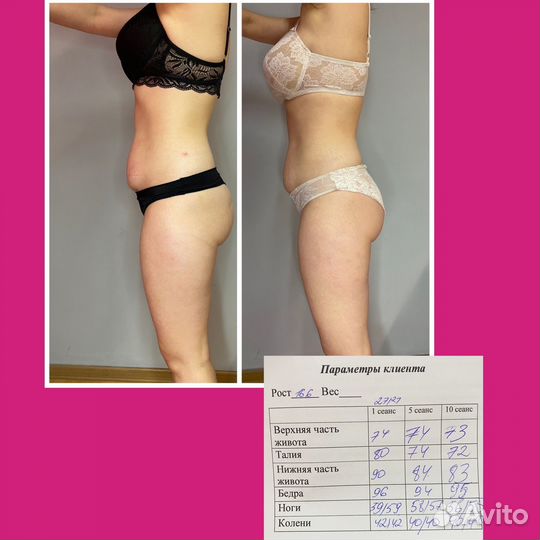 LPG массаж,Коррекция фигуры