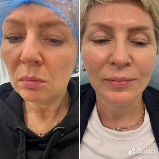 Подтяжка лица эффект с 1 процедуры