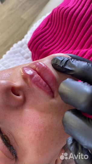 Косметолог. Увеличение губ. Ботокс