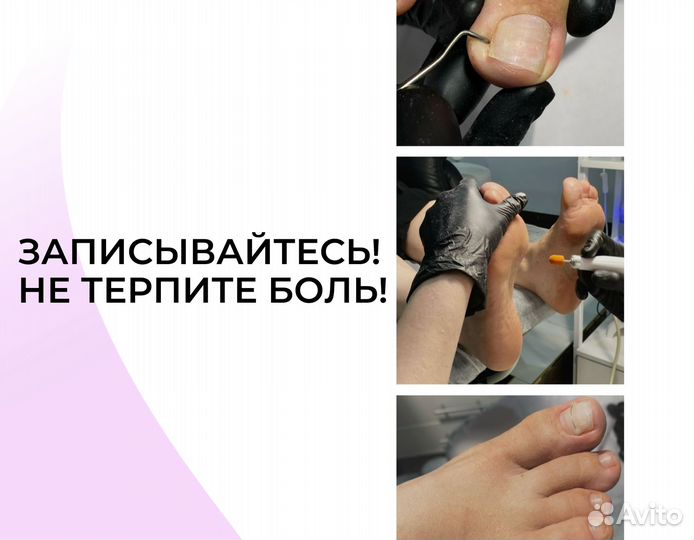 Подолог. Вросший ноготь. Мозоли. Бородавки/Педикюр