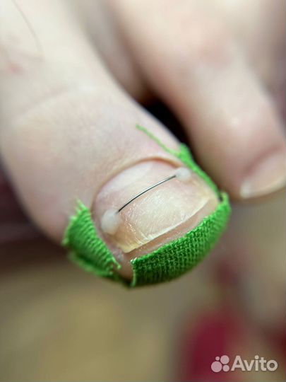 Медицинский педикюр, подолог