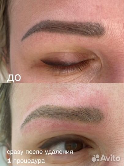 Лазерное удаление тату и татуажа