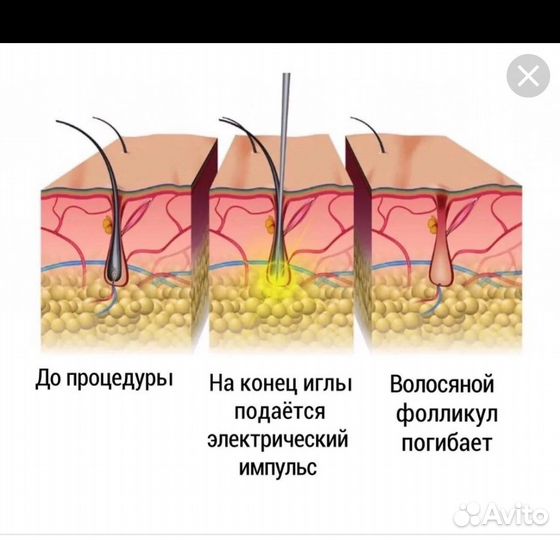 Электроэпиляция