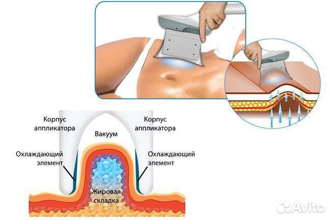 Криолиполиз процедура