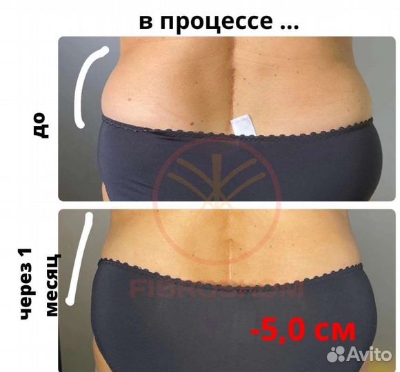 Подтяжка кожи на теле и руках