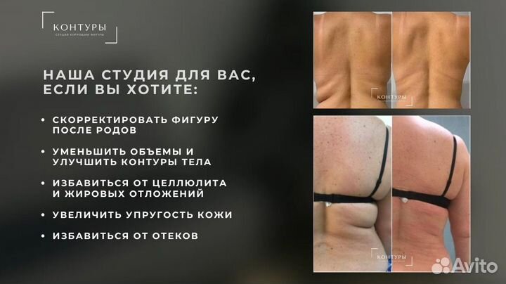 LPG аппаратный массаж