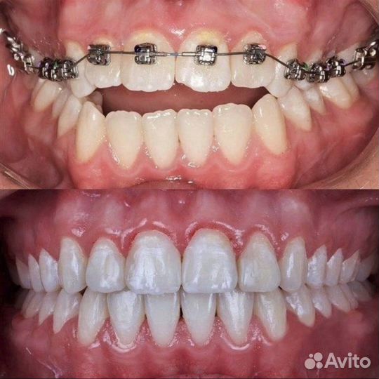 Брекеты установка