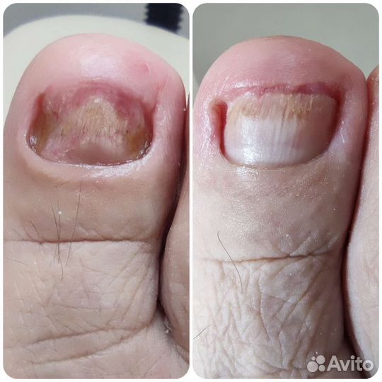 Педикюр Подолог