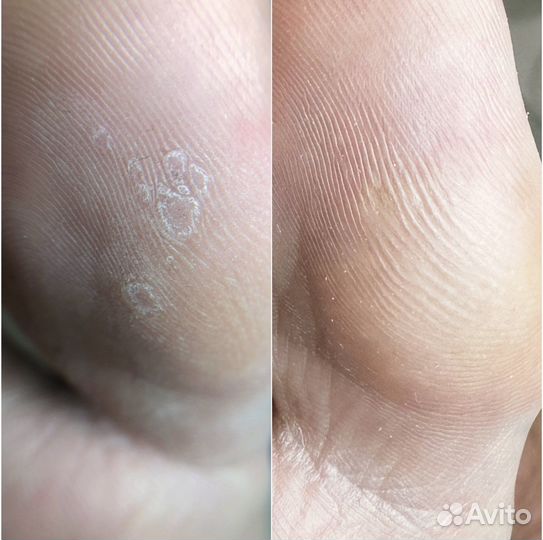 Педикюр подолог центр