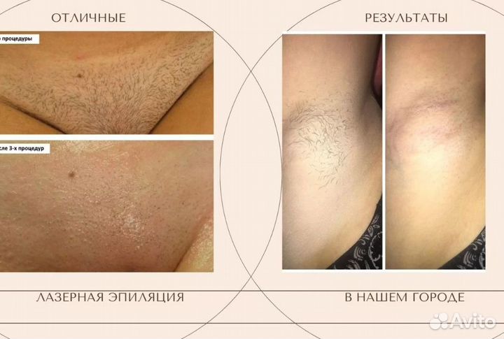 Лазерная эпиляция александритовая+диодная волна
