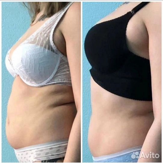 Ищем моделей на подтяжку животика