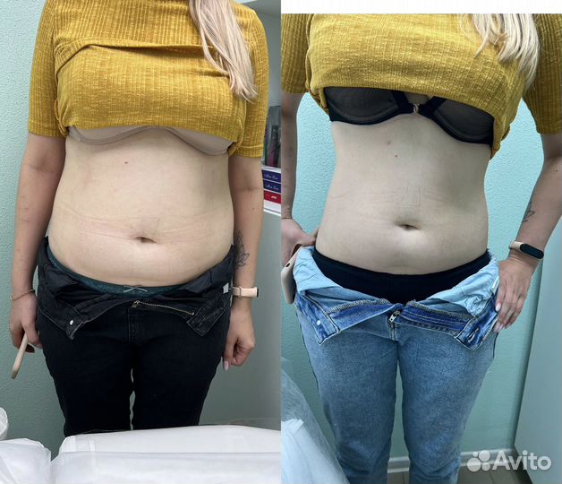 Удаление жира, криолиполиз в ульяновске