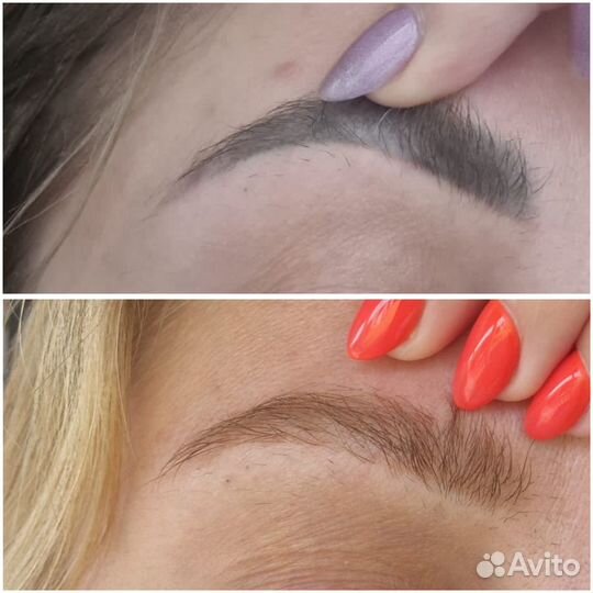 Удаление татуажа и тату лазером / ремувером