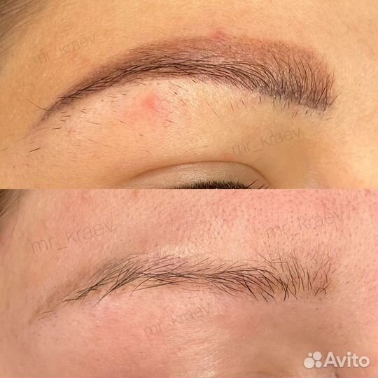 Удаление татуажа, перманента бровей, век, губ