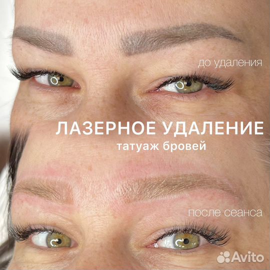 Удаление татуажа бровей/тату