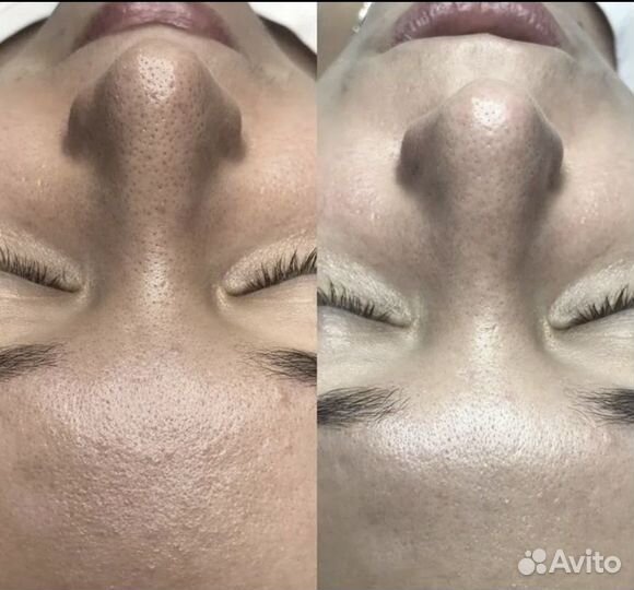 Чистка лица