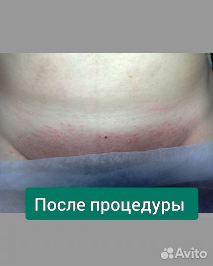 Мастер электроэпиляции