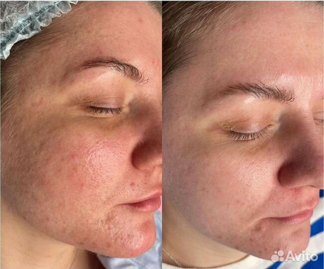 Карбокситерапия oily balance