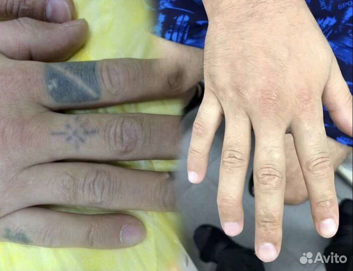 Удаление тату