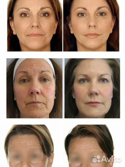 Биоревитализация