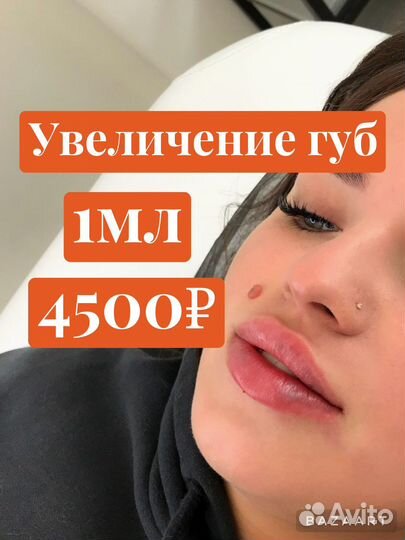 Увеличение губ, увлажнение 0,5мл; 1мл