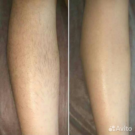 Лазерная эпиляция