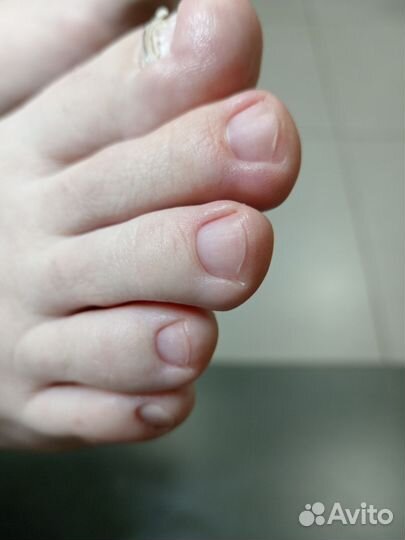 Медицинский педикюр