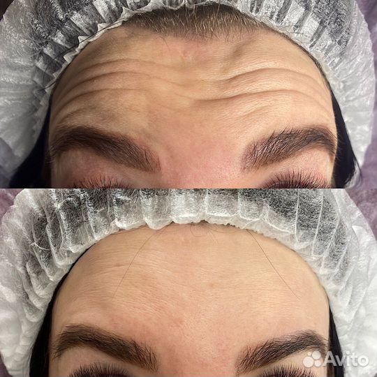 Врач косметолог/ Увеличение губ/ Ботокс